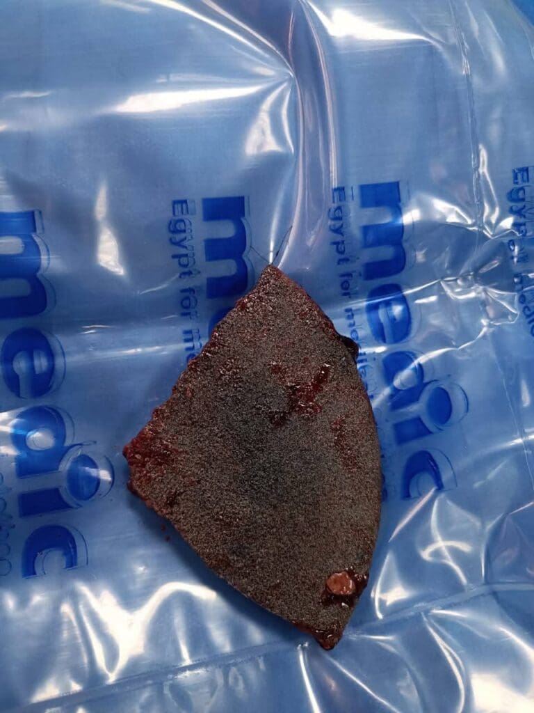 فريق طبي بمستشفي الإصابات الجديد ينجح في استخراج حجر صخري من وجه مريض.. شاهد الصور 1 FB IMG 1735731548158 الإصابات فريق طبي بمستشفي الإصابات الجديد ينجح في استخراج حجر صخري من وجه مريض.. شاهد الصور موقع في الجامعة
