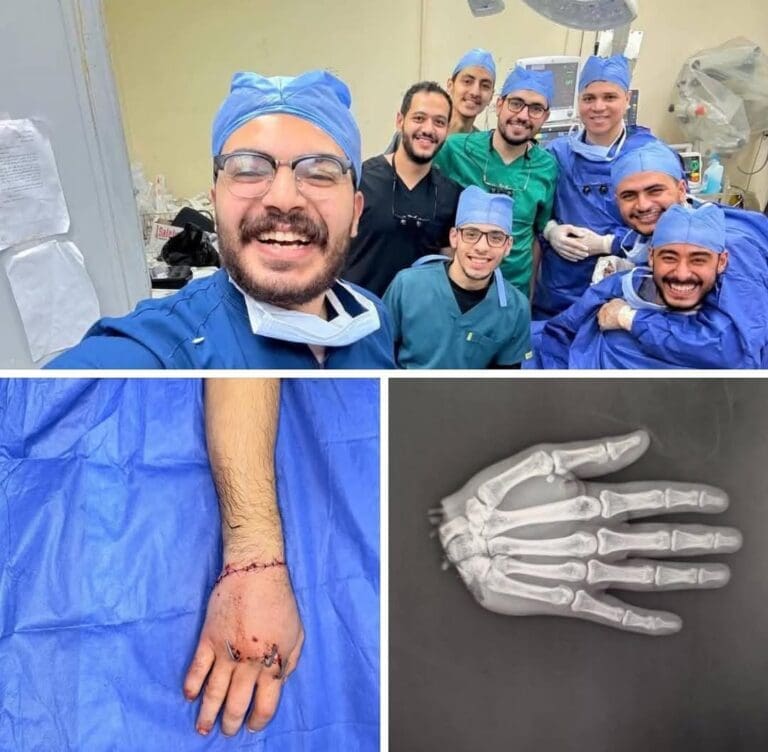 "إنجاز طبي جديد".. إعادة يد مبتورة بعد جراحة دقيقة استغرقت 12 ساعة في طب الأزهر 2 FB IMG 1745325332272 أزياء "إنجاز طبي جديد".. إعادة يد مبتورة بعد جراحة دقيقة استغرقت 12 ساعة في طب الأزهر موقع في الجامعة