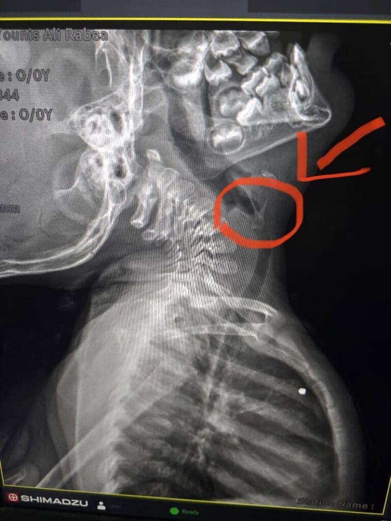 معجزة طبية.. فريق طبي من جامعة سوهاج ينجح استخراج شوكة سمكة من القصبة الهوائية لطفل باستخدام المنظار الجراحي 14 FB IMG 1748620672516 أسيوط معجزة طبية.. فريق طبي من جامعة سوهاج ينجح استخراج شوكة سمكة من القصبة الهوائية لطفل باستخدام المنظار الجراحي موقع في الجامعة