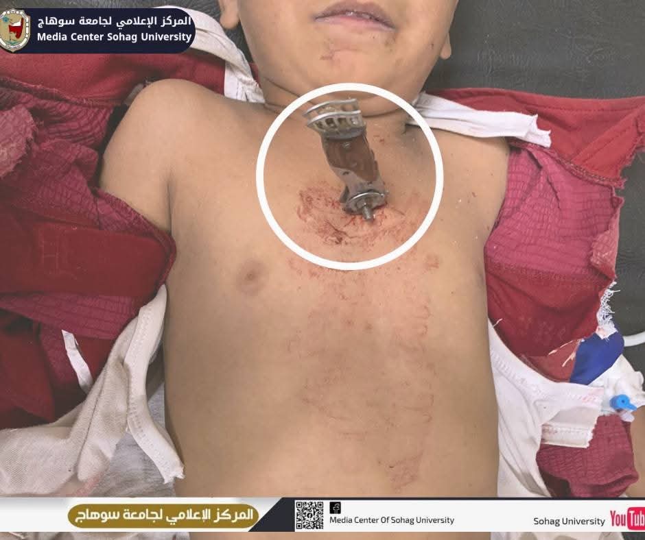 أشبه بالمعجزة.. مستشفيات سوهاج الجامعية تنجح في إنقاذ طفل تعرص لطعنة نافذة بالقلب 1 FB IMG 1750686414993 مستشفيات سوهاج أشبه بالمعجزة.. مستشفيات سوهاج الجامعية تنجح في إنقاذ طفل تعرص لطعنة نافذة بالقلب موقع في الجامعة