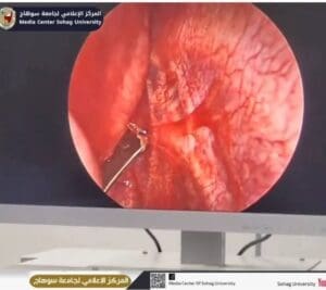 أشبه بالمعجزة.. مستشفيات سوهاج الجامعية تنجح في إنقاذ طفل تعرص لطعنة نافذة بالقلب 2 إنقاذ طفل بطعنة نافذة في القلب